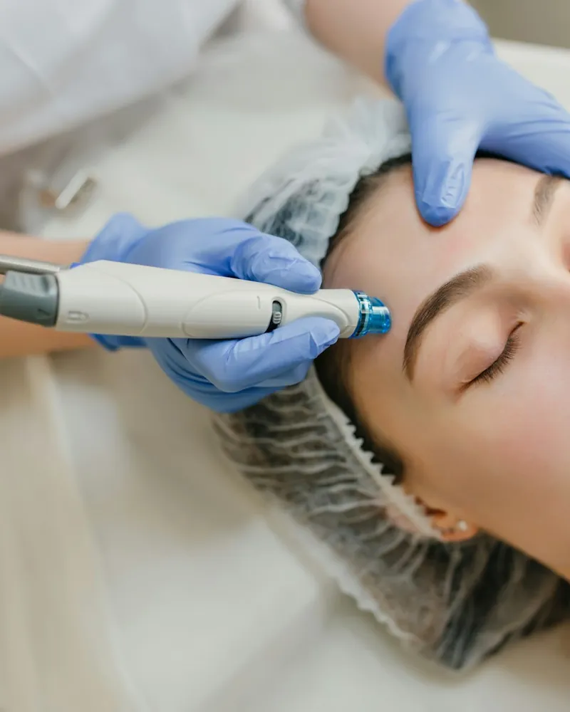Microneedling skin resurfacing treatment being performed